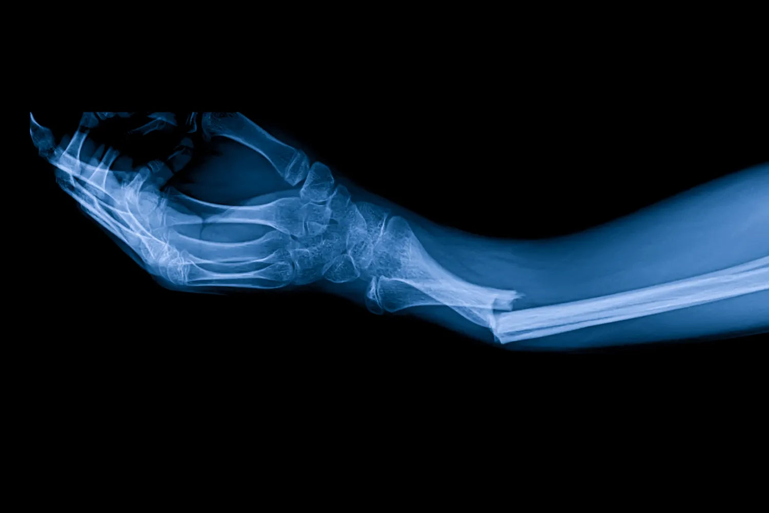 Does Collagen Help Heal Broken Bones?