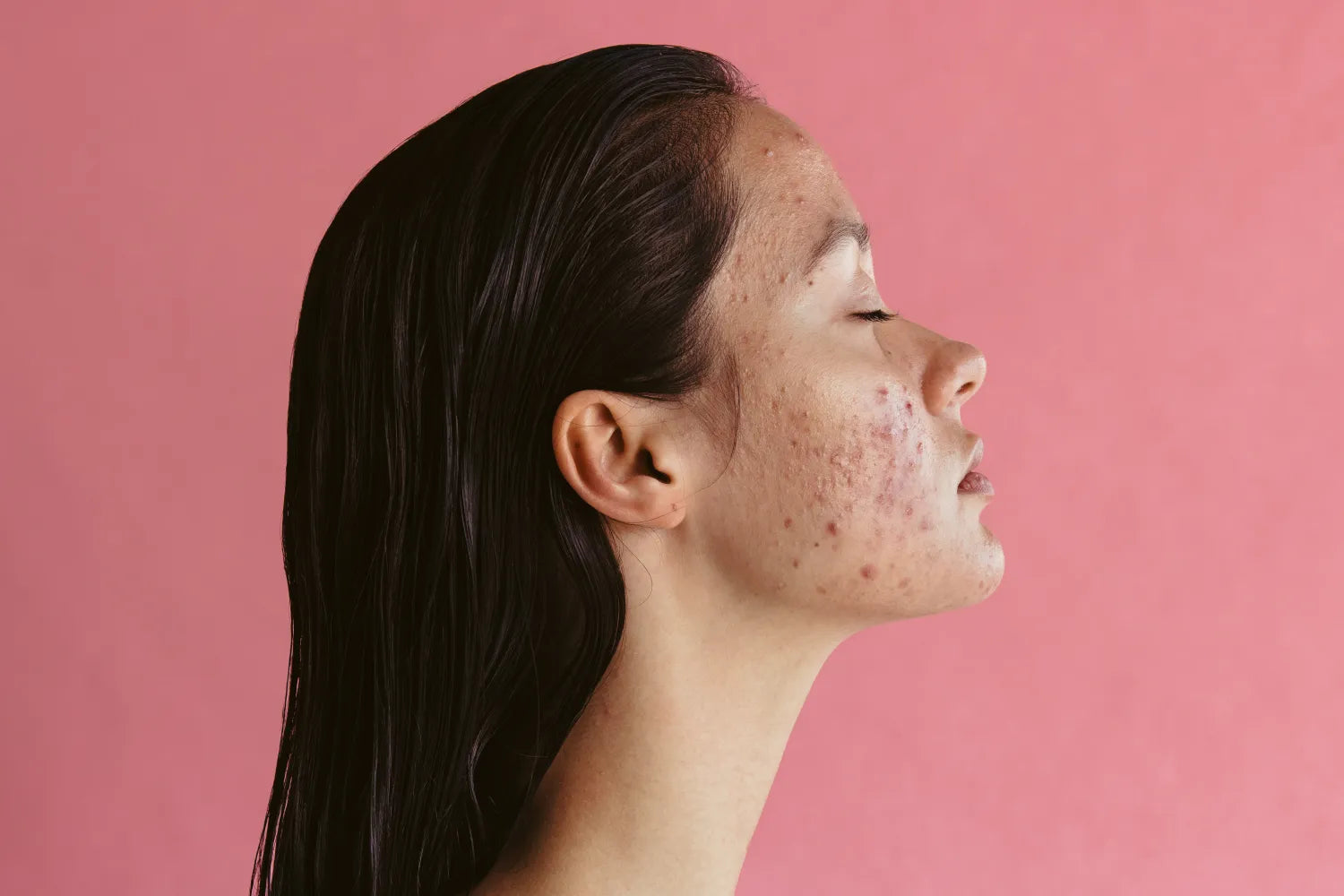 Young woman in profile with eyes closed showing acne and redness on her cheek against a pink background