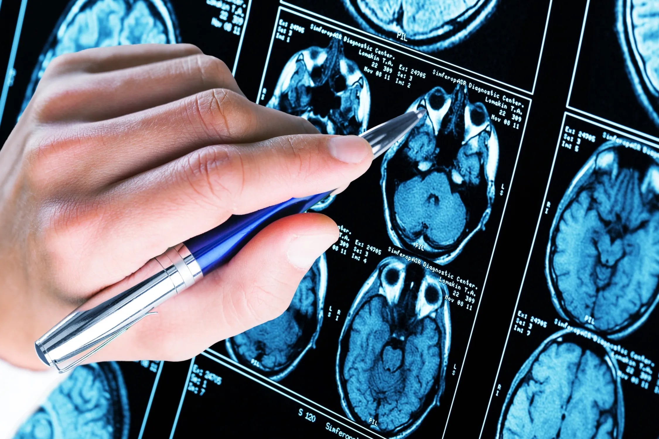 Lion's Mane and Dementia: An Overview of the Science